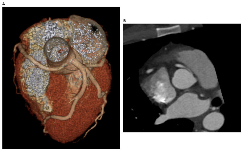 CCTA of anomalous right coronary artery from the left sinus with slit-like ostium and intramural segment