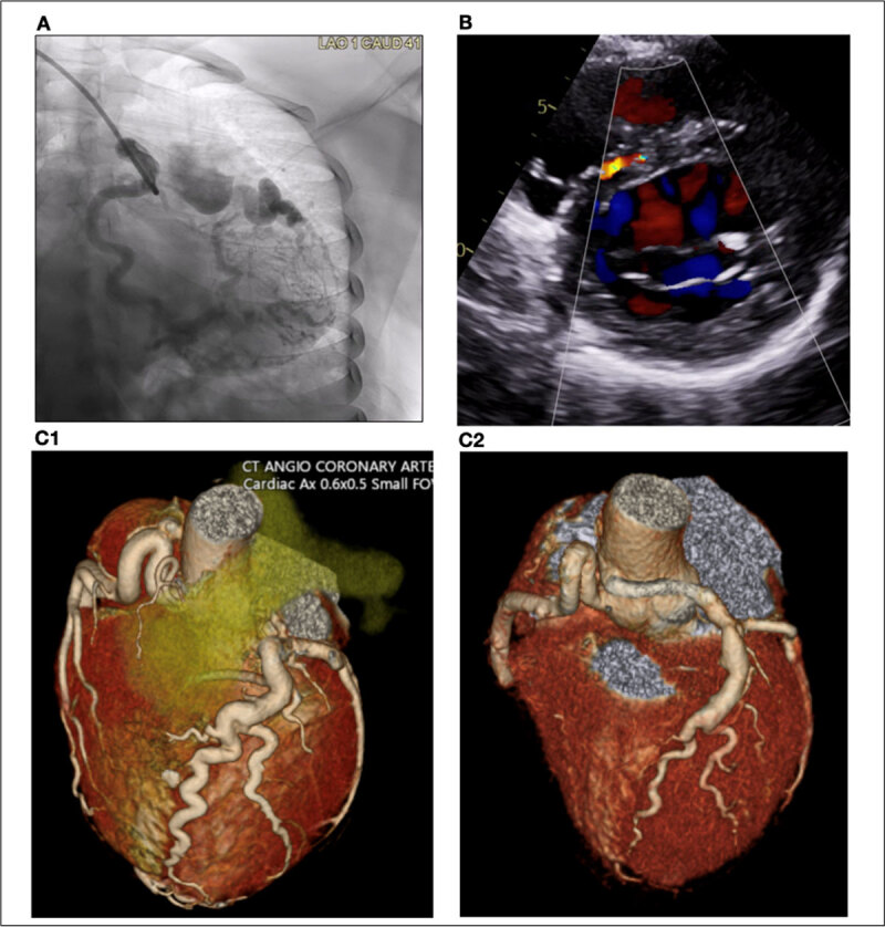 Adult ALCAPA angiography, echocardiography, and pre- and postoperative CT