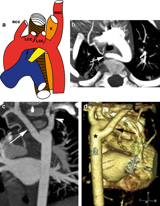 Schematic and CT views of a retroesophageal aberrant right subclavian artery