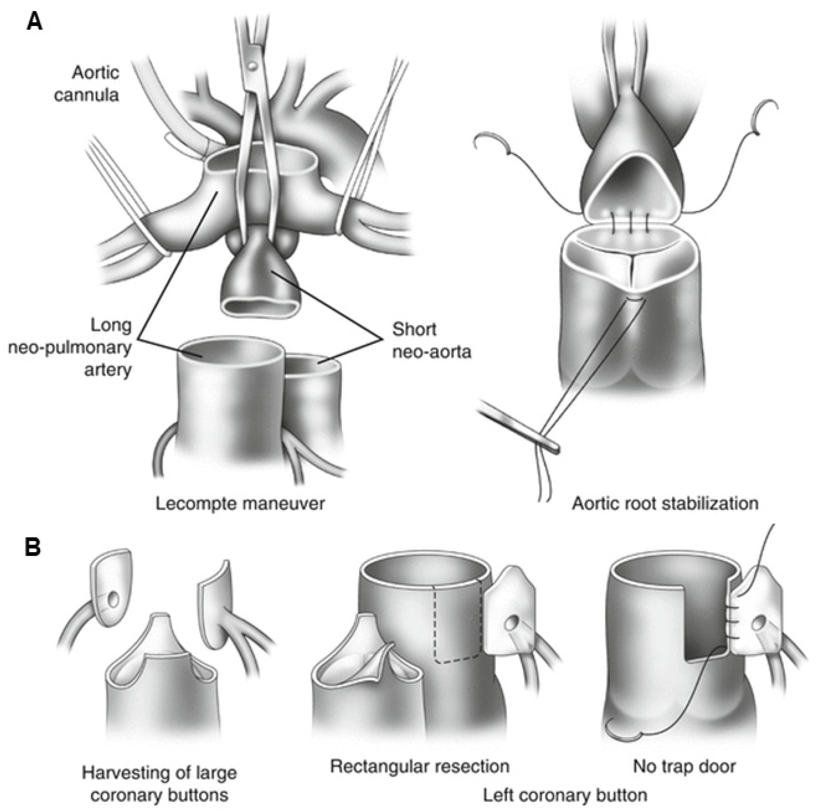 Steps of arterial switch operation including Lecompte maneuver and coronary transfer