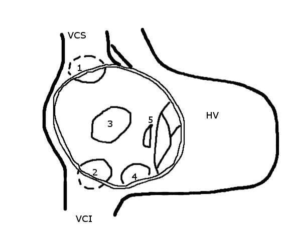 Schematic of secundum, primum and sinus venosus atrial septal defects