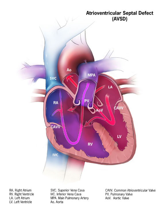 Complete atrioventricular septal defect anatomy