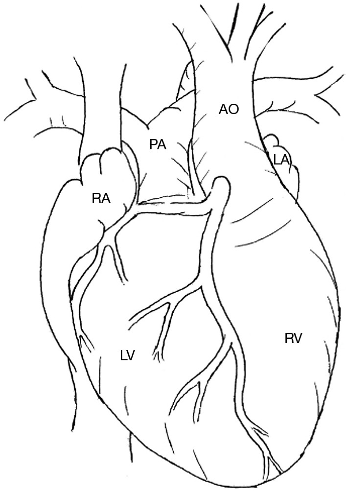Anatomy of congenitally corrected transposition of the great arteries