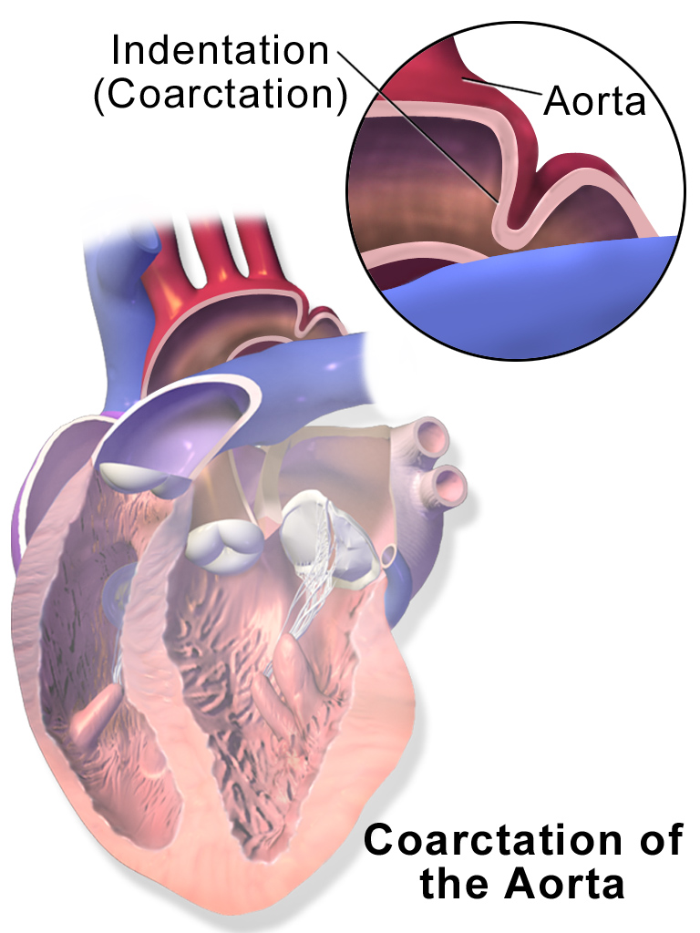 Coarctation of the aorta anatomy