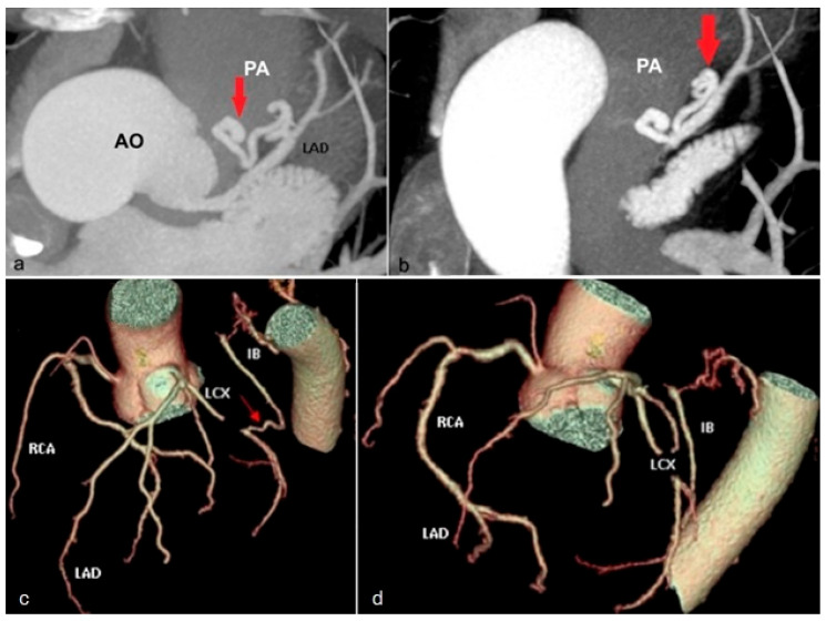CT of LAD-to-pulmonary artery fistula and extracardiac coronary termination