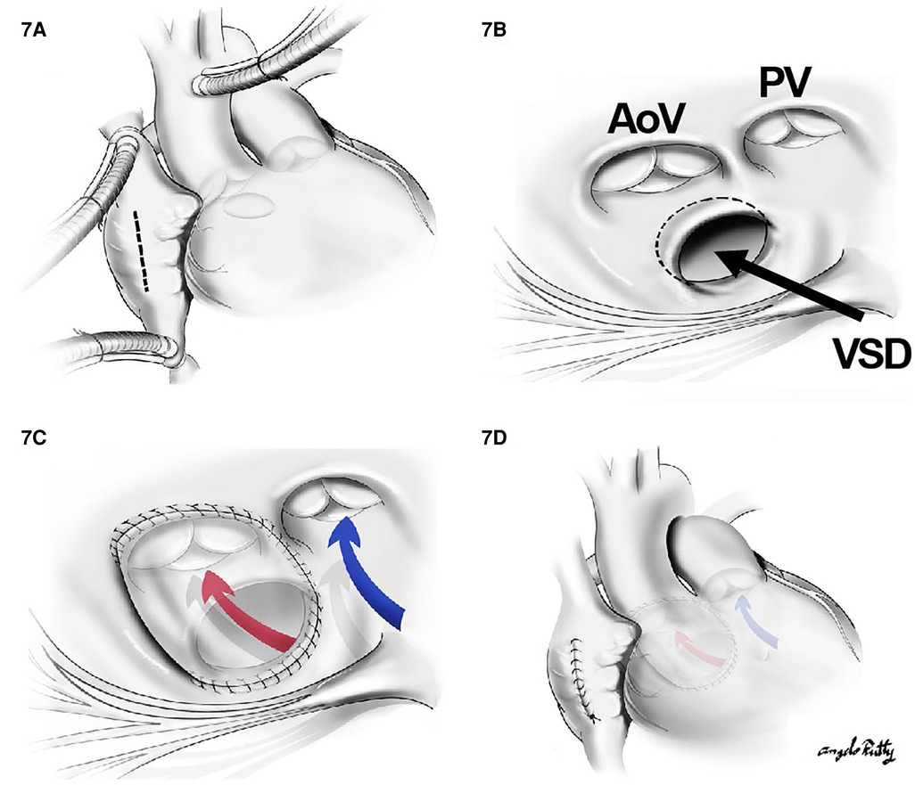 Double outlet right ventricle repaired with LV to aorta intraventricular tunnel