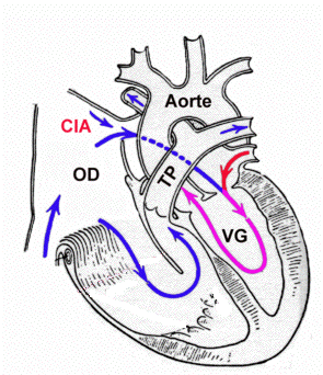 Ebstein anomaly with apical displacement of the tricuspid valve