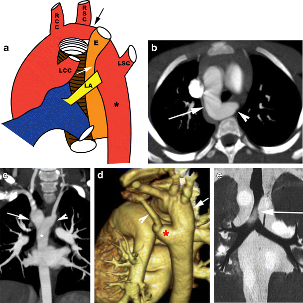Right aortic arch, aberrant left subclavian artery and Kommerell diverticulum