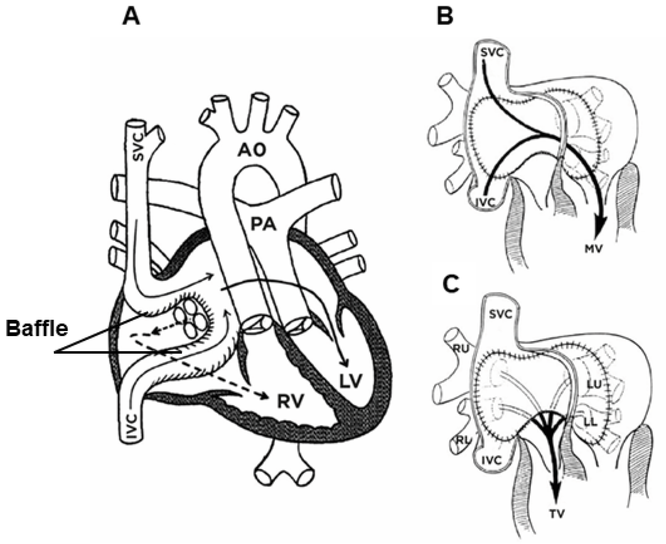 Atrial switch baffle pathways after Mustard or Senning operation