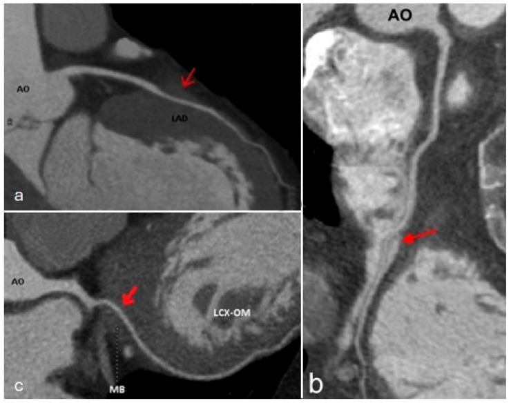 Curved CCTA reformats of myocardial bridging in the LAD, RCA and LCx