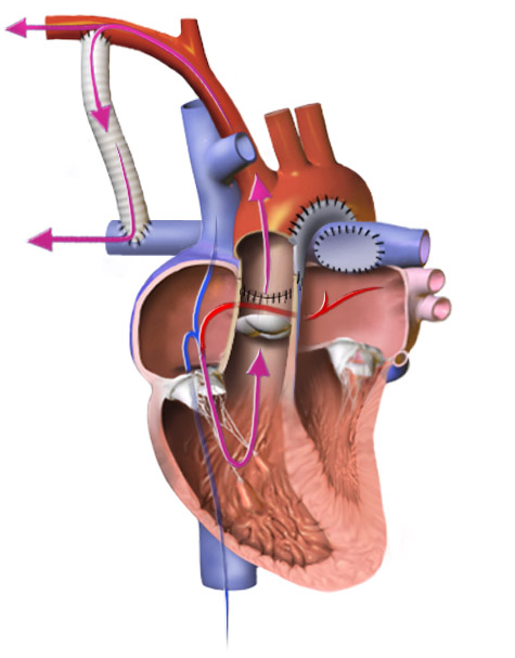 Norwood reconstruction for hypoplastic left heart syndrome