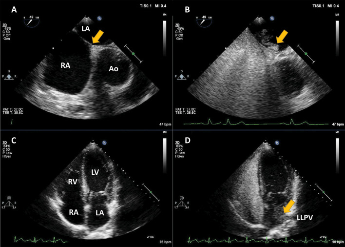 Contrast echocardiography comparing immediate bubbles crossing a patent foramen ovale with delayed bubbles arriving from a pulmonary vein