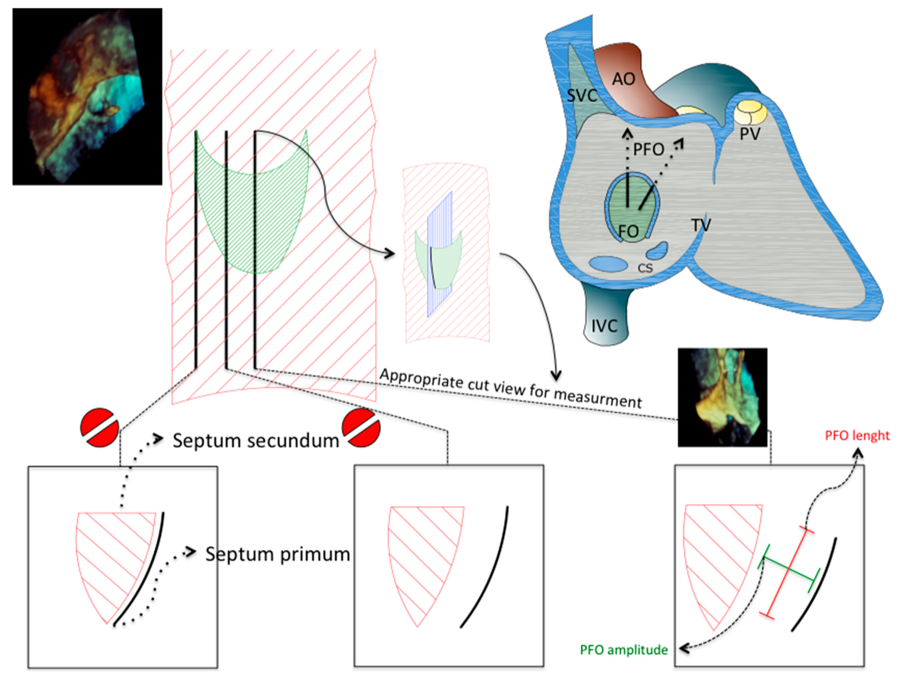 Anatomic and three-dimensional transesophageal echo views of the patent foramen ovale flap tunnel