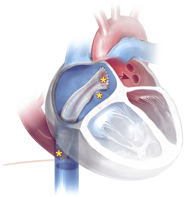 Conventional intracardiac baffle repair of Scimitar vein