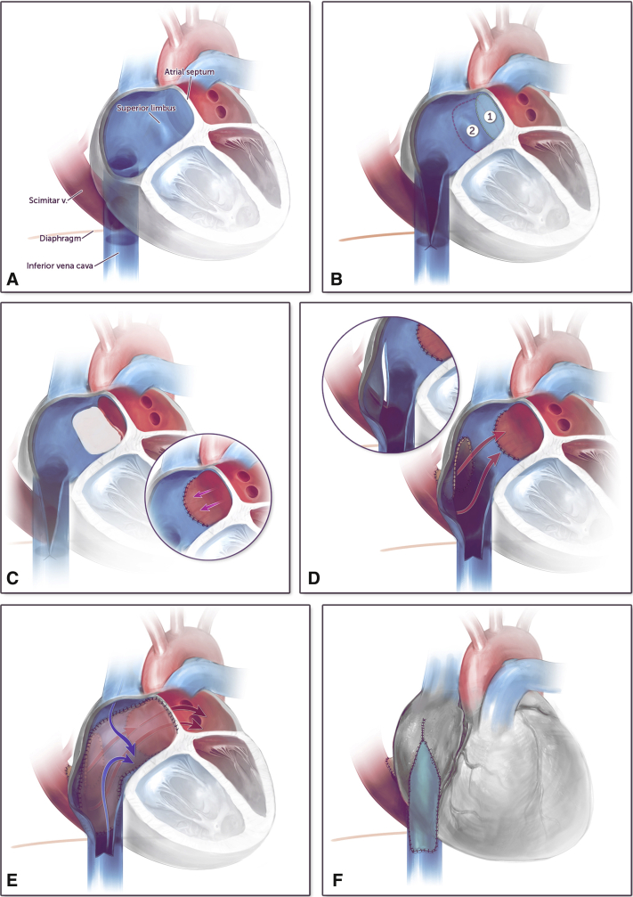 Multipatch repair of Scimitar syndrome