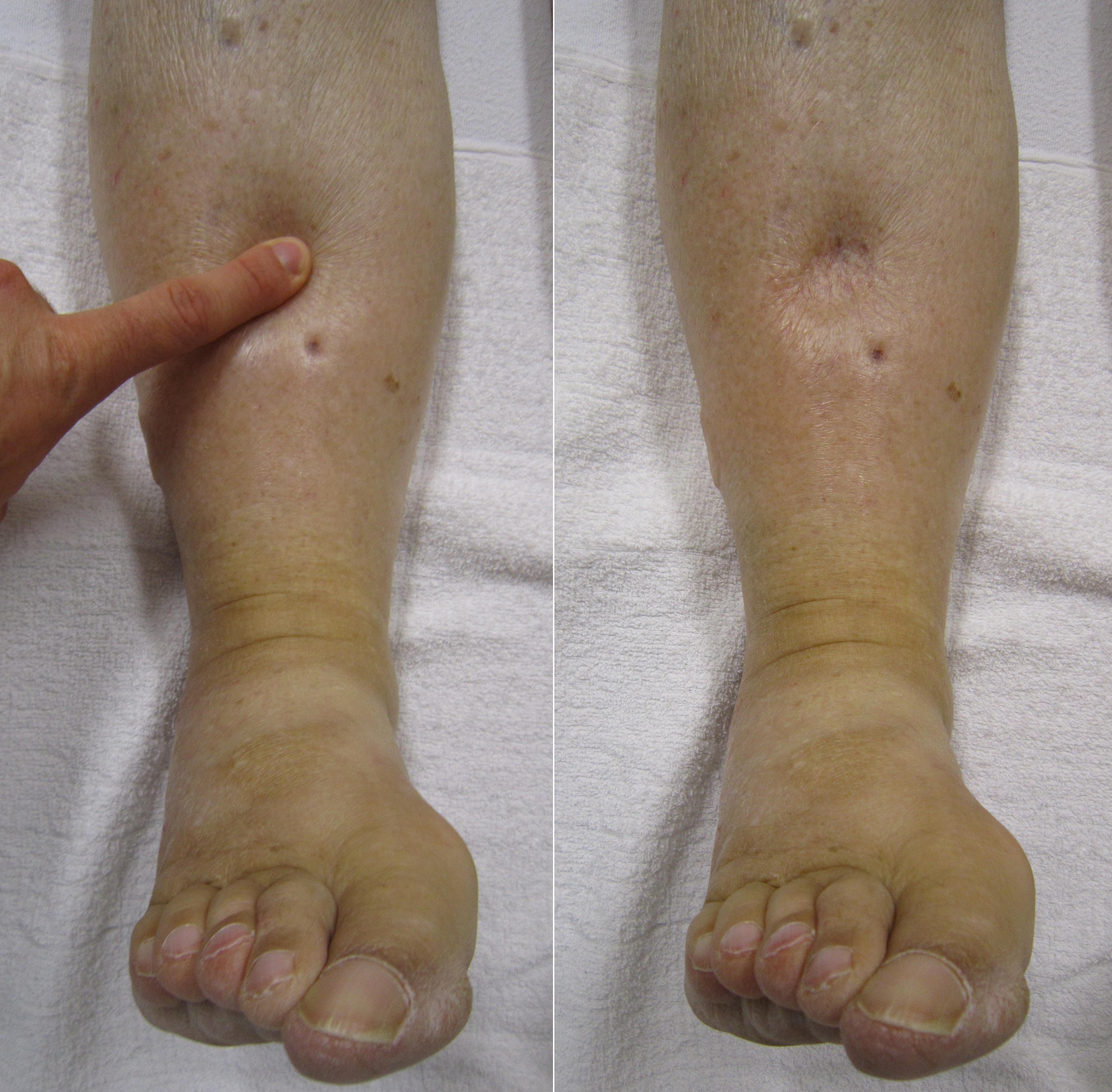 Pressure applied to the lower leg and the persistent indentation after release, demonstrating pitting edema