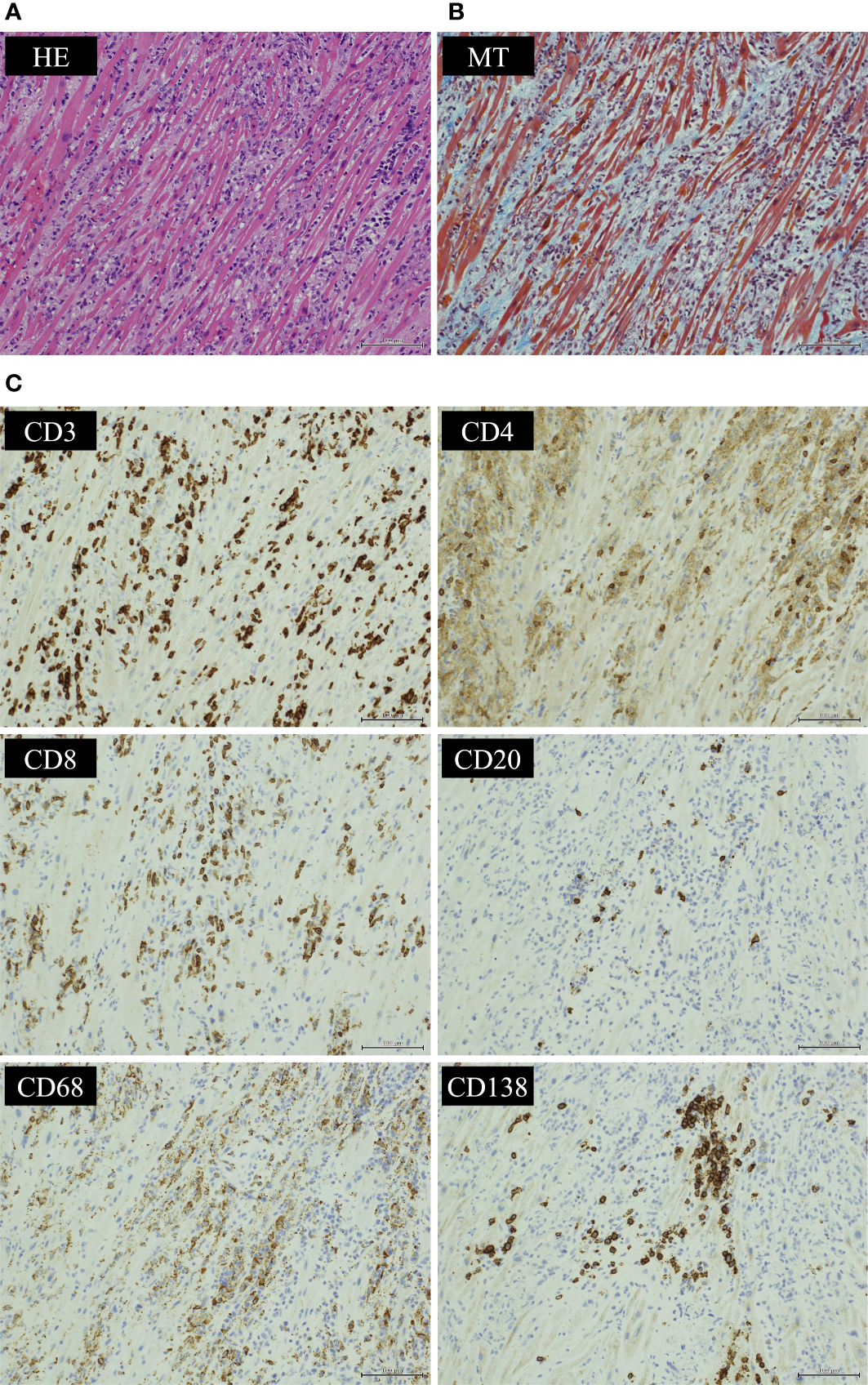 Published endomyocardial biopsy with H&E and Masson trichrome panels, followed by CD3, CD4, CD8, CD20, CD68 and CD138 immunostains. Lymphocytes infiltrate the myocardium, with more CD8-positive than CD4-positive T cells in this case.