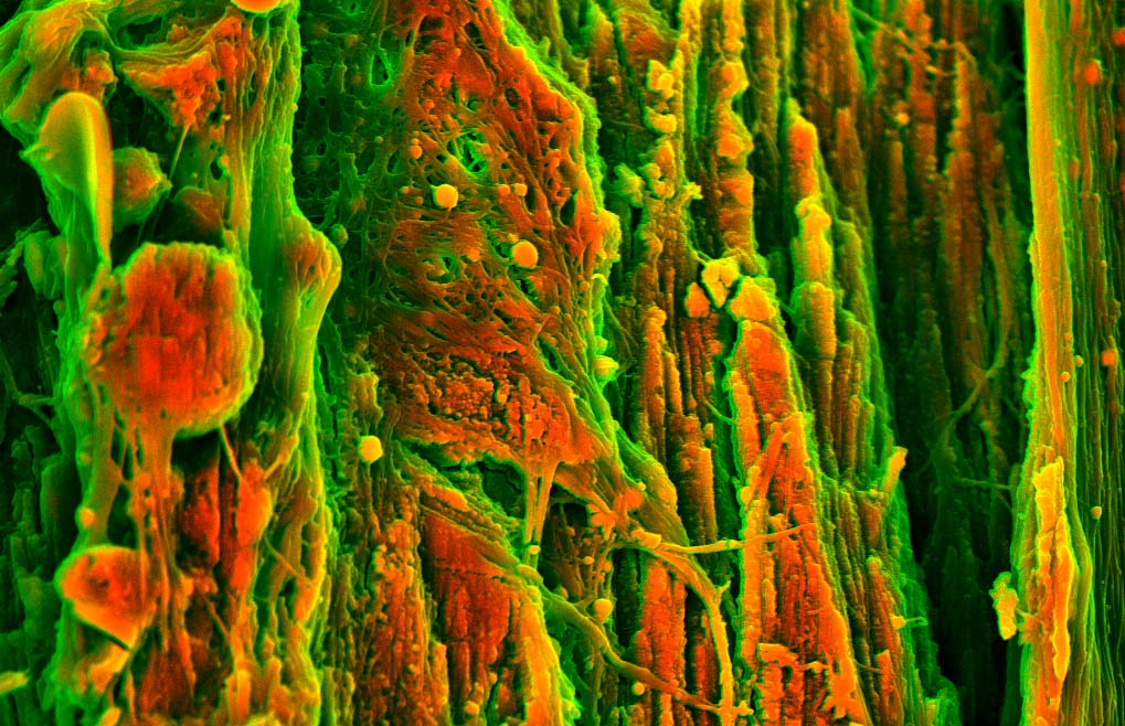 Colorized scanning electron micrograph of carotid plaque, with orange calcification among green collagen layers.