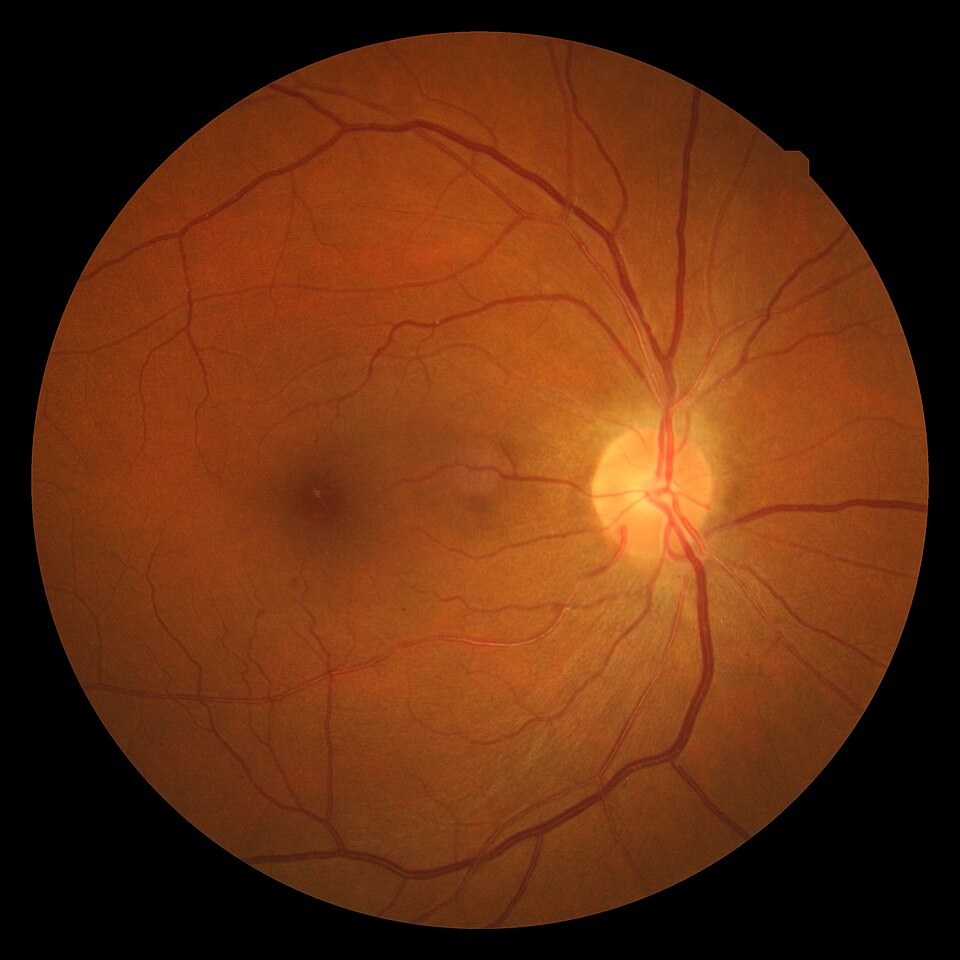 Fundus photograph labeled hypertensive retinopathy by the source, illustrating chronic retinal vascular changes