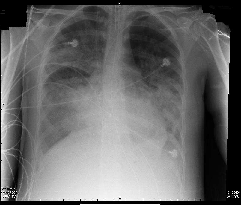 Published chest radiograph showing bilateral air-space opacities in a patient described as having ARDS. The image alone cannot identify the edema mechanism.