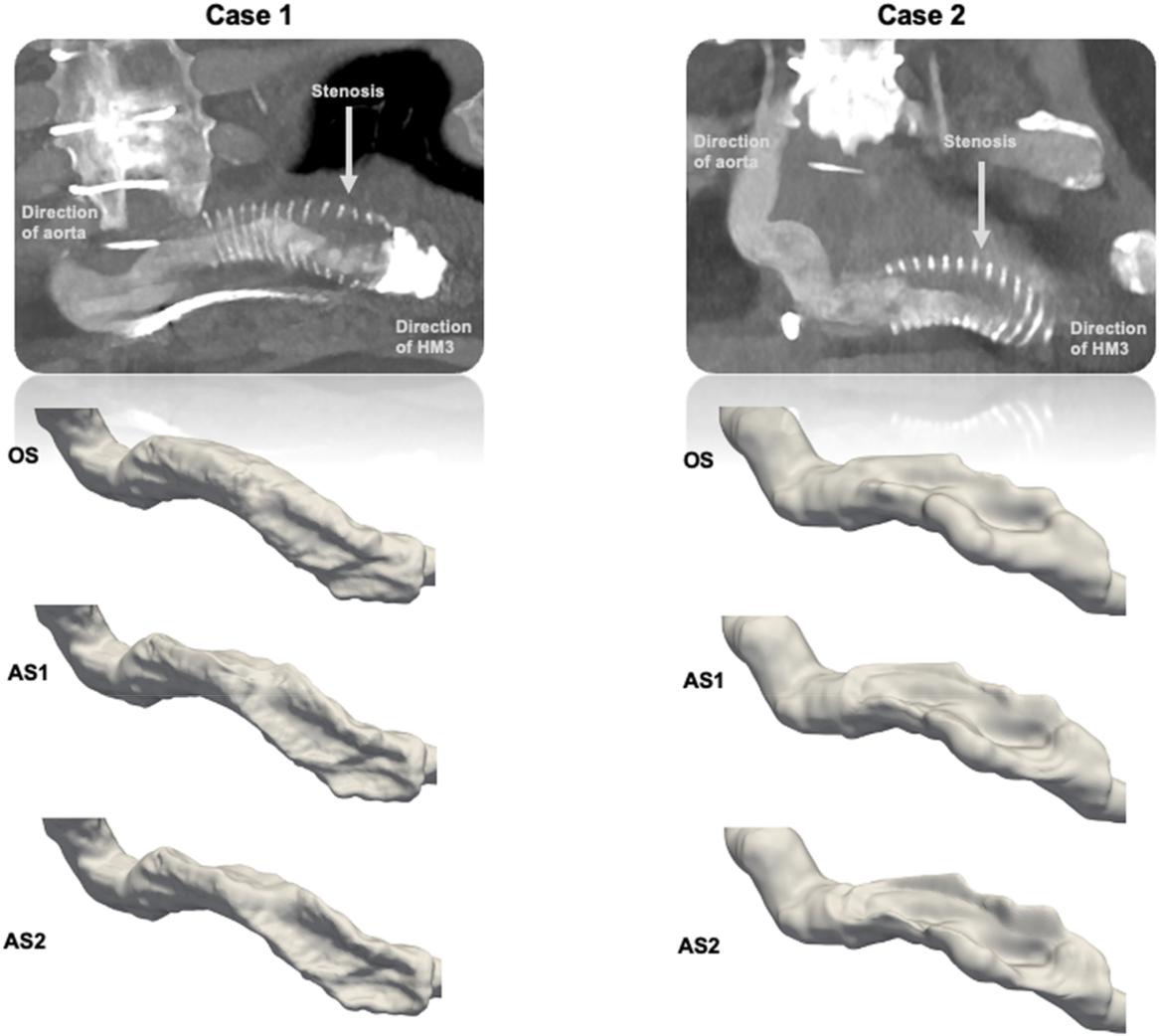 Figure 1 from Ohlsson and colleagues: CT images of two HeartMate 3 outflow graft stenoses above, and segmented original and virtually augmented graft geometries below