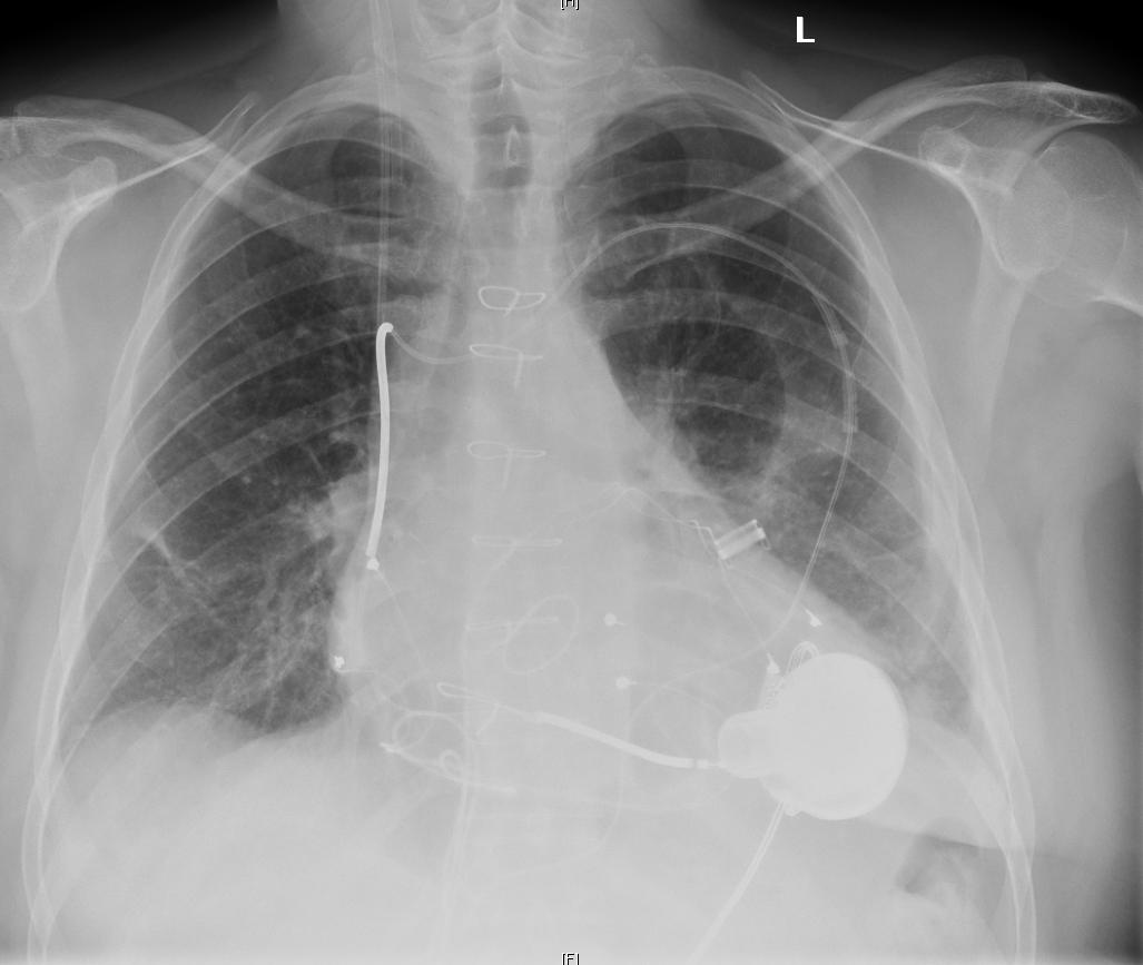 Chest radiograph showing an implanted HeartWare HVAD and an implantable cardioverter-defibrillator