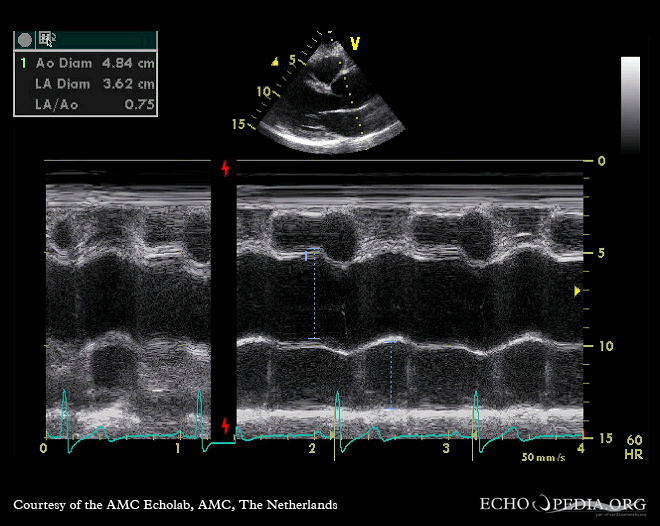 Aortic root M-mode showing aortic root motion and valve opening