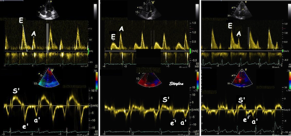 Three paired mitral inflow and annular tissue Doppler examples showing normal relaxation, impaired relaxation with normal filling pressure, and impaired relaxation with elevated filling pressure