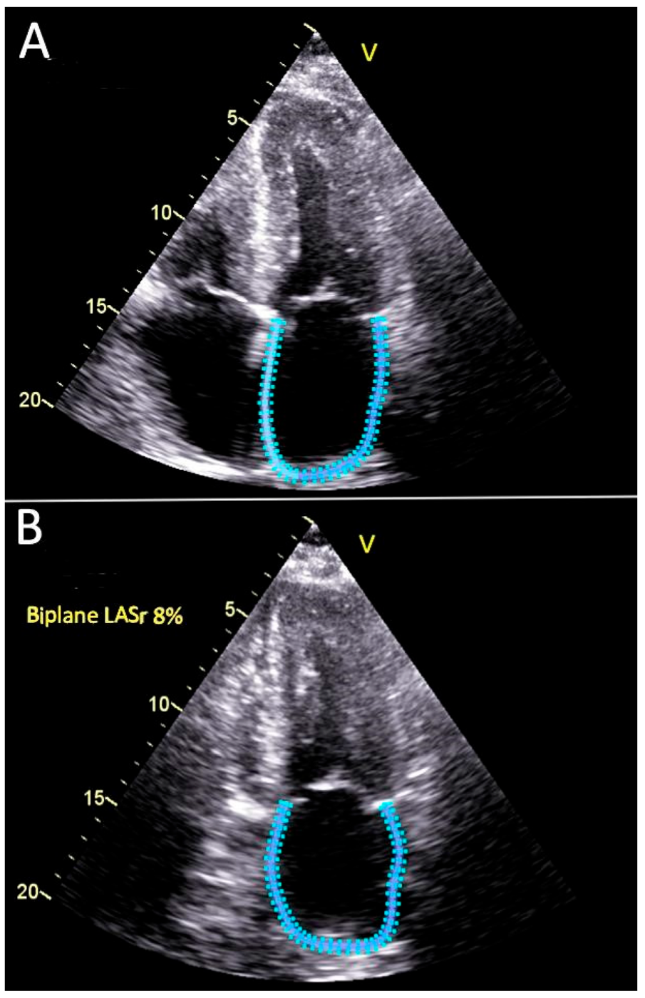 Automated left atrial speckle-tracking contours demonstrating reduced biplane reservoir strain of eight percent