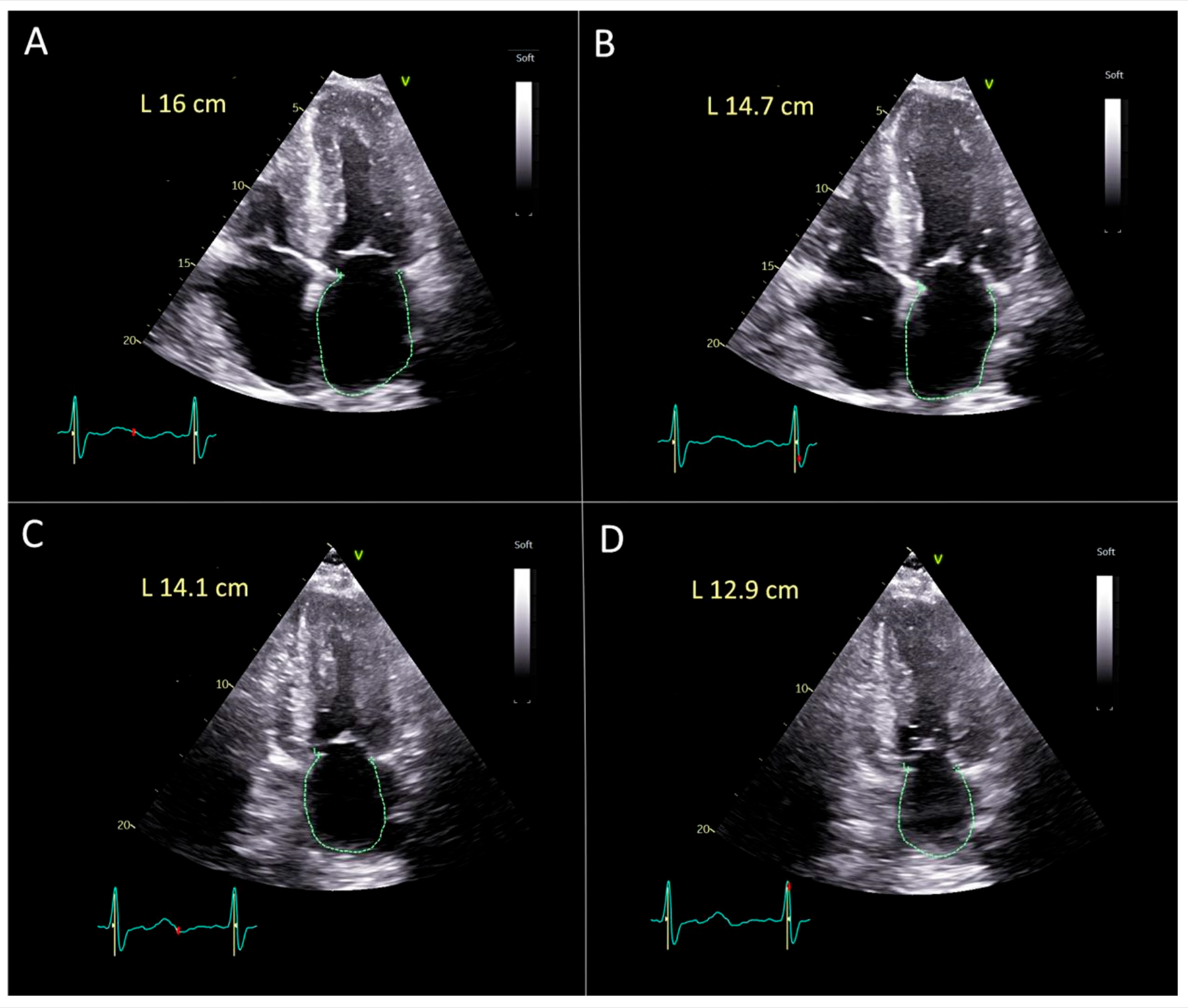 Four apical echocardiographic frames with left atrial wall lengths used to illustrate reservoir strain calculation