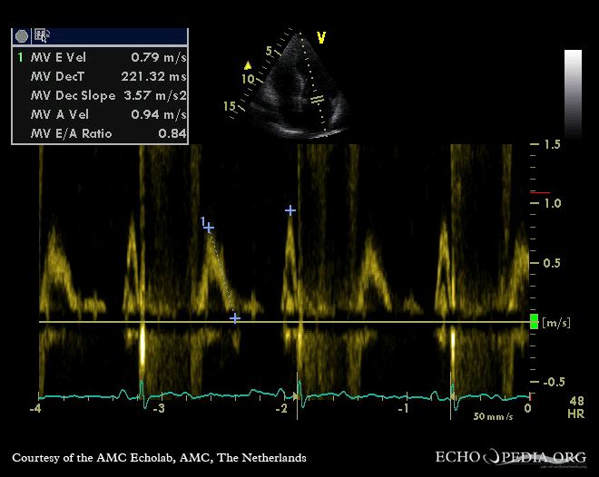 Pulsed-wave mitral inflow with E smaller than A in impaired relaxation