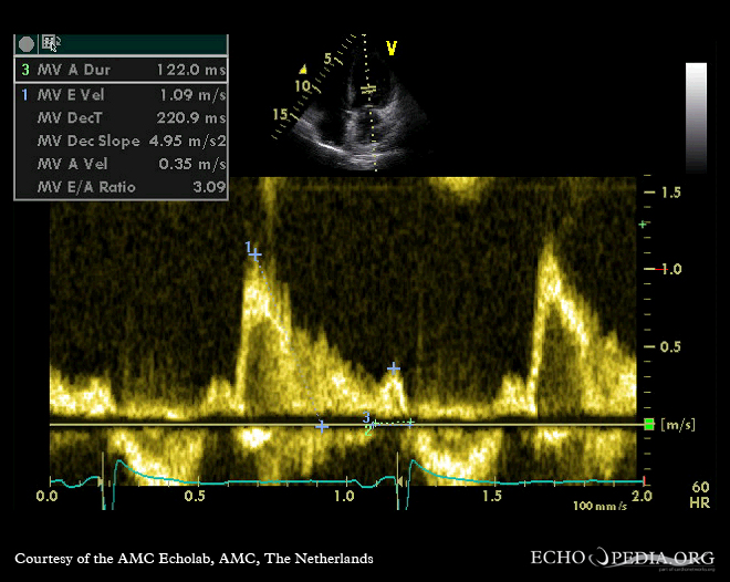 Pulsed-wave mitral inflow with E larger than A in a pseudonormal filling pattern