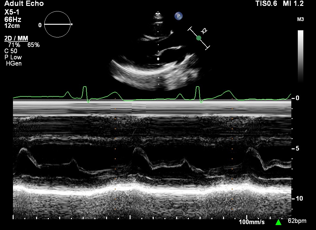 M-mode interrogation of the mitral valve showing the E and A excursions