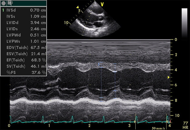 Parasternal long-axis M-mode cursor and left ventricular dimension tracing