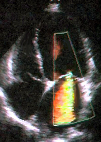 Apical four-chamber color Doppler echocardiogram demonstrating severe mitral regurgitation