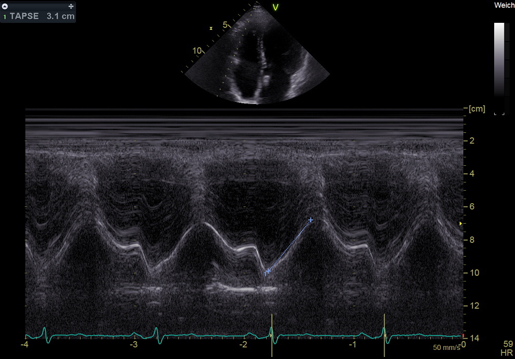M-mode tracing of tricuspid annular plane systolic excursion