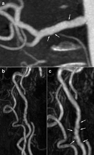 Three panels showing right renal artery irregularity on CTA in panel a and internal carotid string-of-beads appearance on MRA in panels b and c, marked with white arrows.