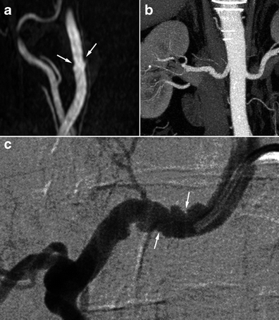 Three panels showing subtle internal carotid beading on MRA in panel a, right renal artery beading on CTA in panel b, and the same renal string-of-beads pattern on catheter angiography in panel c.