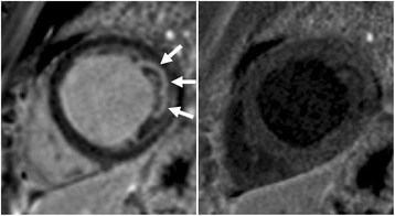 Paired short-axis CMR: apparent bright lateral-wall signal on the left disappears with dark-blood suppression on the right, revealing blood in trabeculae rather than scar.