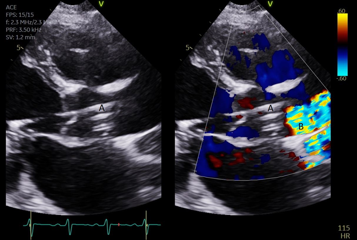 Paired parasternal long-axis echo images with Impella outlet A and color flow B in the ascending aorta above the aortic valve
