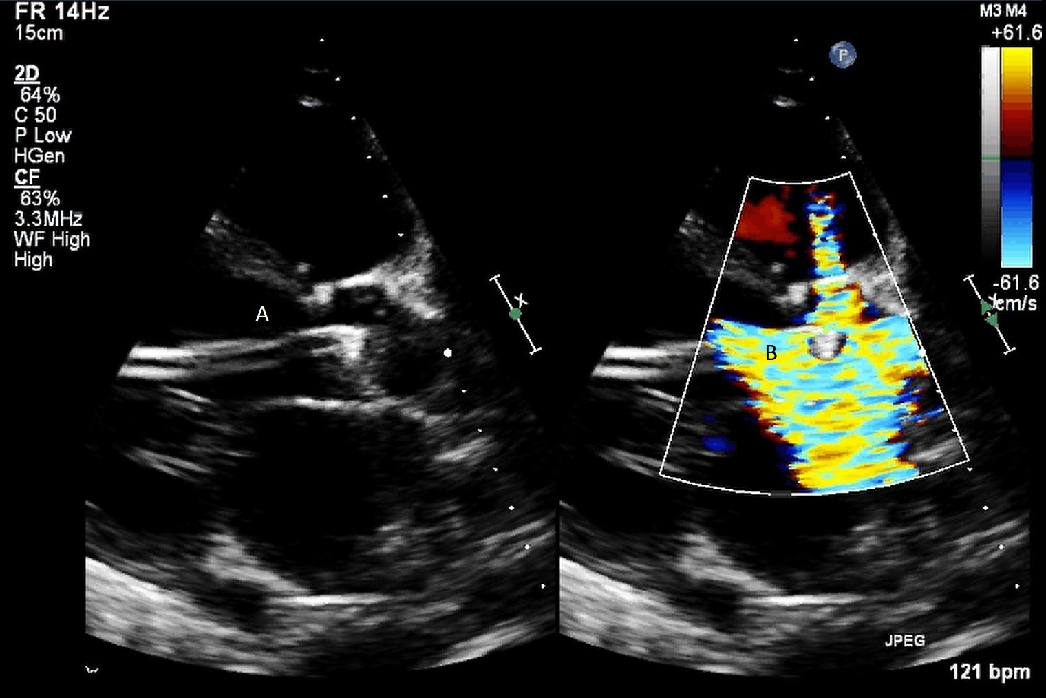 Paired parasternal long-axis echo images showing Impella A and outlet color flow B below the aortic valve in the LV outflow tract