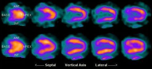 Cardiac SPECT example comparing uncorrected and attenuation-corrected views