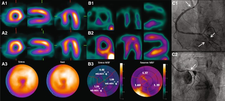 Relative SPECT, oxygen-15 water PET flow maps and angiography in balanced multivessel coronary disease