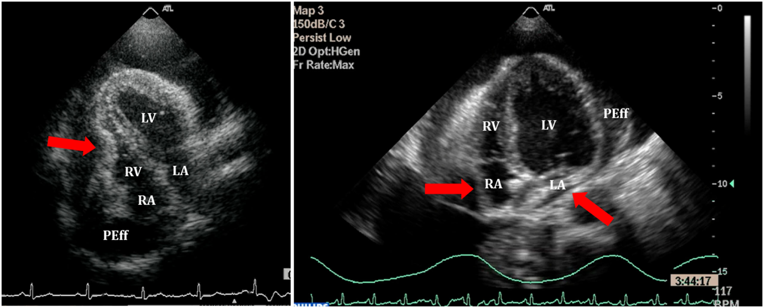 Published paired echocardiograms. Left red arrow marks early-diastolic RV collapse. Right red arrows mark collapse of both atria in a different patient, with visible surrounding pericardial effusion.