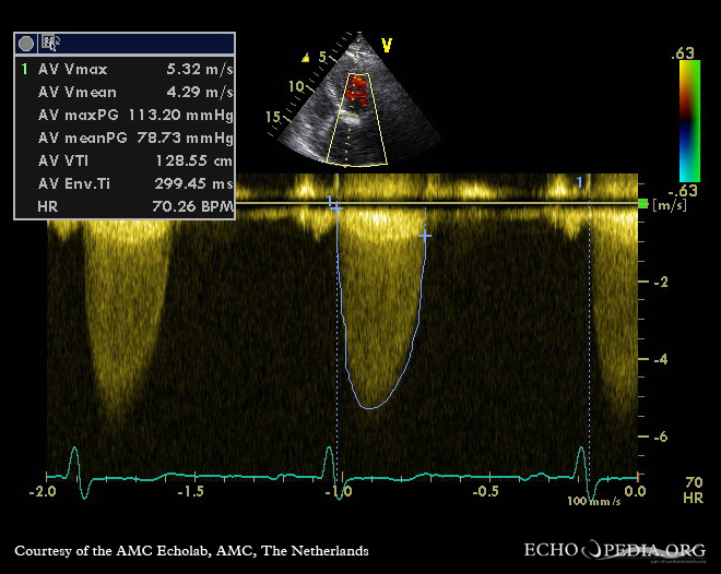 Archived aortic stenosis CW Doppler tracing with Vmax 5.32 m/s, peak gradient 113.20 mmHg and mean gradient 78.73 mmHg.