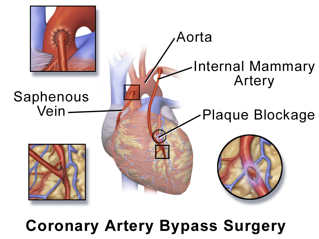 Labeled CABG illustration showing an internal mammary artery conduit and a saphenous vein graft connecting to native coronary arteries beyond plaque.