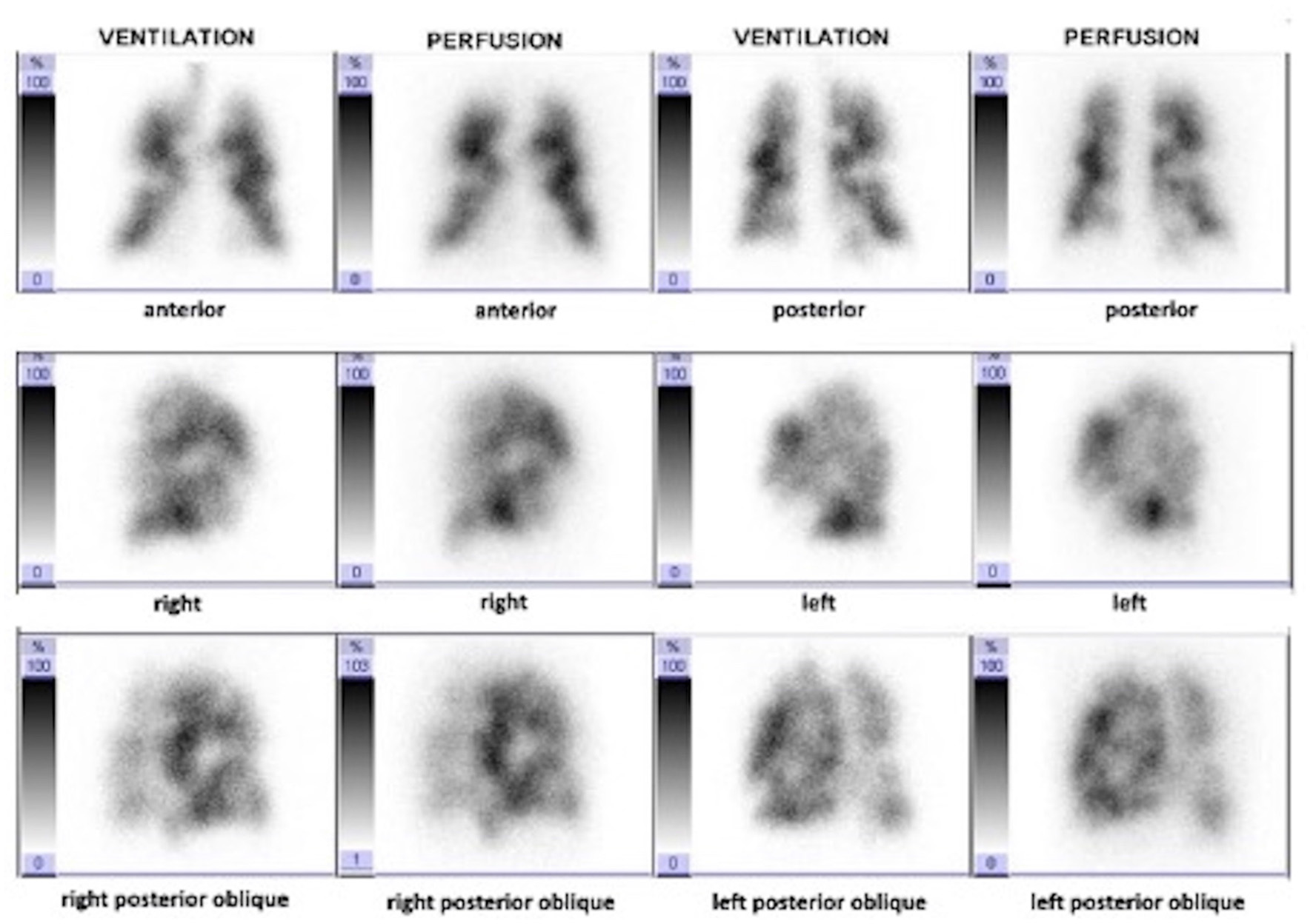 Published planar ventilation and perfusion scans in paired anterior, posterior, lateral and oblique views. Multiple perfusion defects coincide with ventilation abnormalities in this non-CTEPH example.