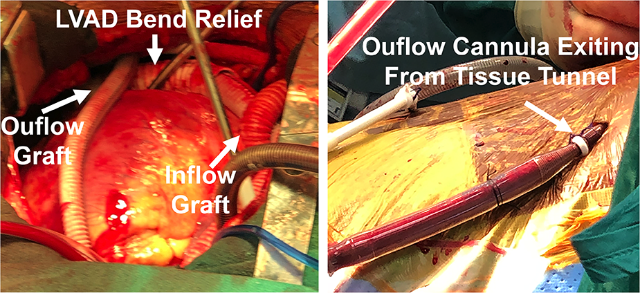 Published operative photographs show RVAD inflow and outflow grafts, with the return cannula emerging through a subcutaneous tunnel.
