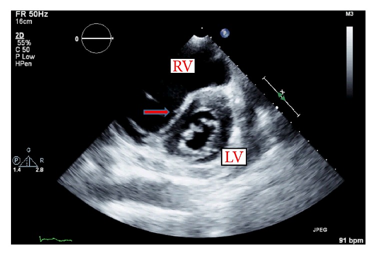 Published parasternal short-axis echocardiogram. A large anterior RV displaces the septum toward a D-shaped LV. The original red arrow points at the septum.