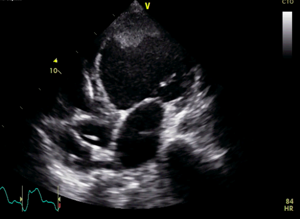 Published apical four-chamber echocardiogram from an adult on VA-ECMO shows thrombus at the LV apex near the top of the image.